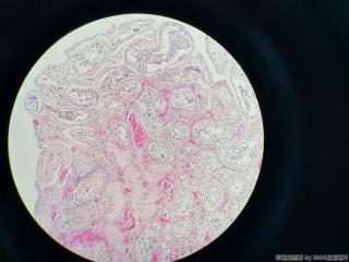 睾丸鞘膜外肿物图5