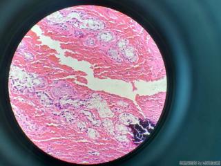 胆囊壁层可见大量腺体图16