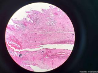 胆囊壁层可见大量腺体图17