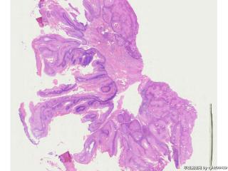 疣状癌/乳头状瘤？图19