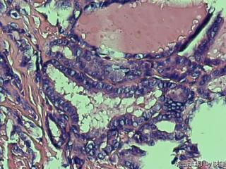 乳头状癌？图18