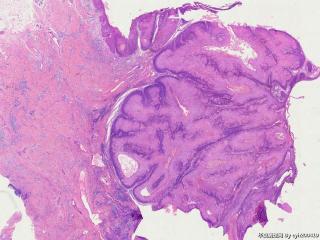 疣状癌/乳头状瘤？图2