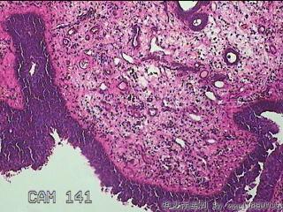 鼻腔新生物图19