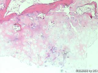 骨软骨瘤？图3