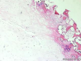 骨软骨瘤？图1