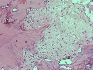 骨软骨瘤？图6