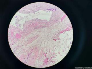 胆囊腔内见大量絮状物，镜下见粘液样成分图6