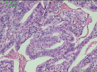 贲门活检组织，高分化腺癌？请教！图6