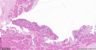 请各位老师帮看看这个胆囊的这些区域，腺瘤性息肉，高级别？图3