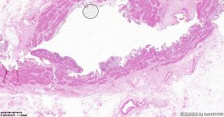 请各位老师帮看看这个胆囊的这些区域，腺瘤性息肉，高级别？图2