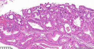 请各位老师帮看看这个胆囊的这些区域，腺瘤性息肉，高级别？图7