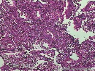 宫腔内组织图14