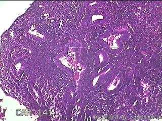 宫腔内组织图31