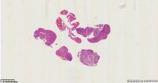 结膜新生物图1