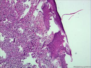 皮隆突性纤维肉瘤？纤维组织细胞瘤？恶性？图4