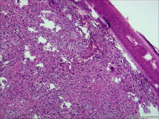 皮隆突性纤维肉瘤？纤维组织细胞瘤？恶性？图3