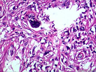 皮隆突性纤维肉瘤？纤维组织细胞瘤？恶性？图33