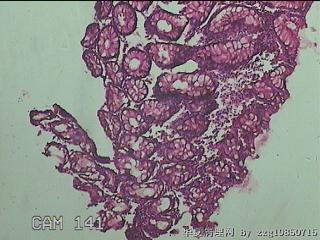 直乙结肠粘膜图6