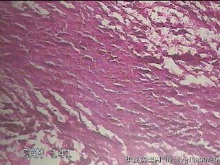 结肠系膜肿物（结石）图19
