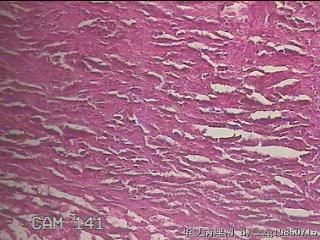 结肠系膜肿物（结石）图18