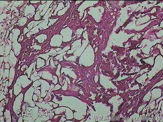 结肠系膜肿物（结石）图7