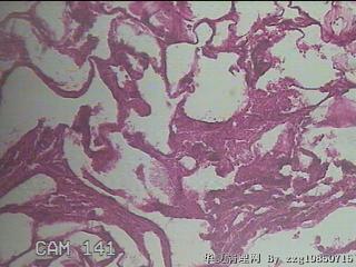 结肠系膜肿物（结石）图46