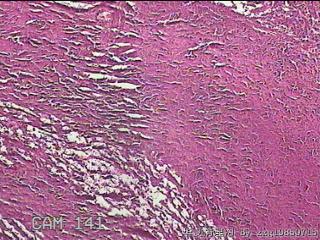 结肠系膜肿物（结石）图3