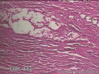 结肠系膜肿物（结石）图17