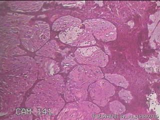 结肠系膜肿物（结石）图24