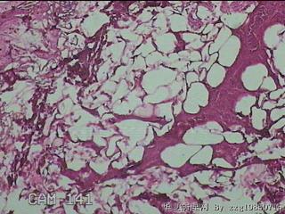 结肠系膜肿物（结石）图6