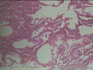 结肠系膜肿物（结石）图30