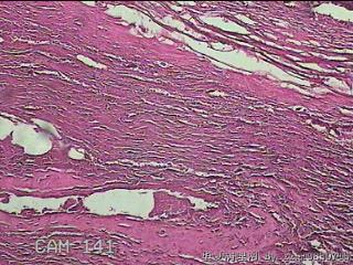 结肠系膜肿物（结石）图4