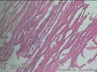 结肠系膜肿物（结石）图15
