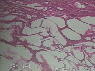 结肠系膜肿物（结石）图40