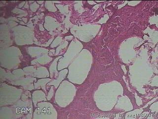 结肠系膜肿物（结石）图22