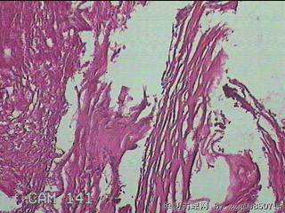 结肠系膜肿物（结石）图1