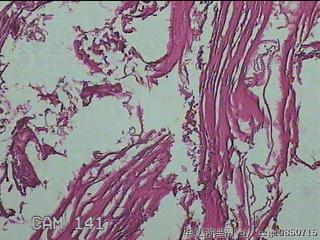 结肠系膜肿物（结石）图2