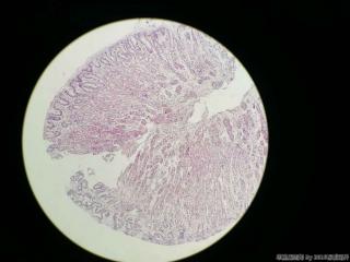 胃体活检，临床及胃镜高度疑癌图11
