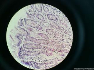 胃体活检，临床及胃镜高度疑癌图3