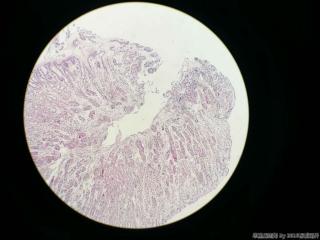 胃体活检，临床及胃镜高度疑癌图14