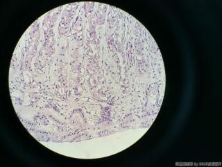 胃体活检，临床及胃镜高度疑癌图13
