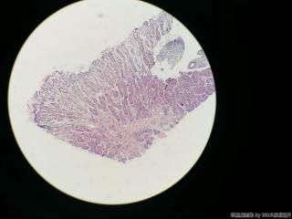 胃体活检，临床及胃镜高度疑癌图9