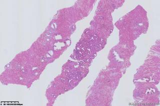 前列腺穿刺组织图14