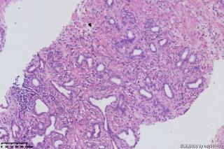 前列腺穿刺组织图18