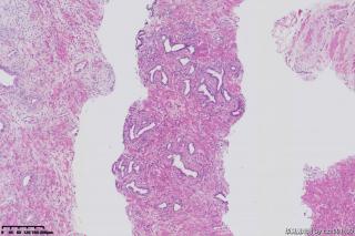 前列腺穿刺组织图7