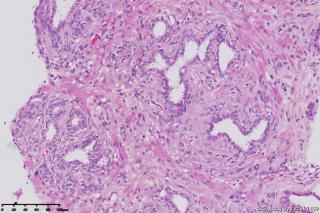 前列腺穿刺组织图12