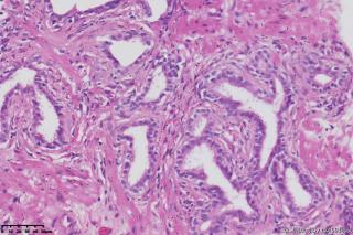 前列腺穿刺组织图9