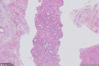 前列腺穿刺组织图10