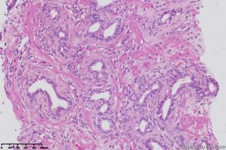 前列腺穿刺组织图11