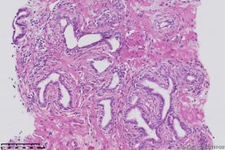 前列腺穿刺组织图8